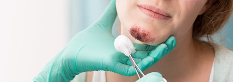 wound care treatment