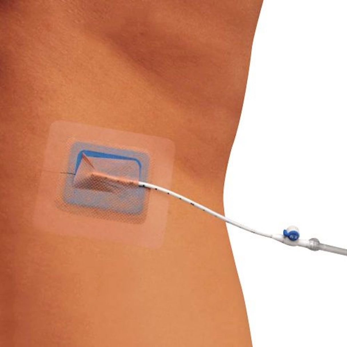 Image of Merit StayFIX® Small Catheter Fastener – Fits 5–12 Fr Catheters (680ME)
