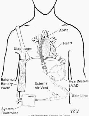 Image of LVAD Management System, Chronic